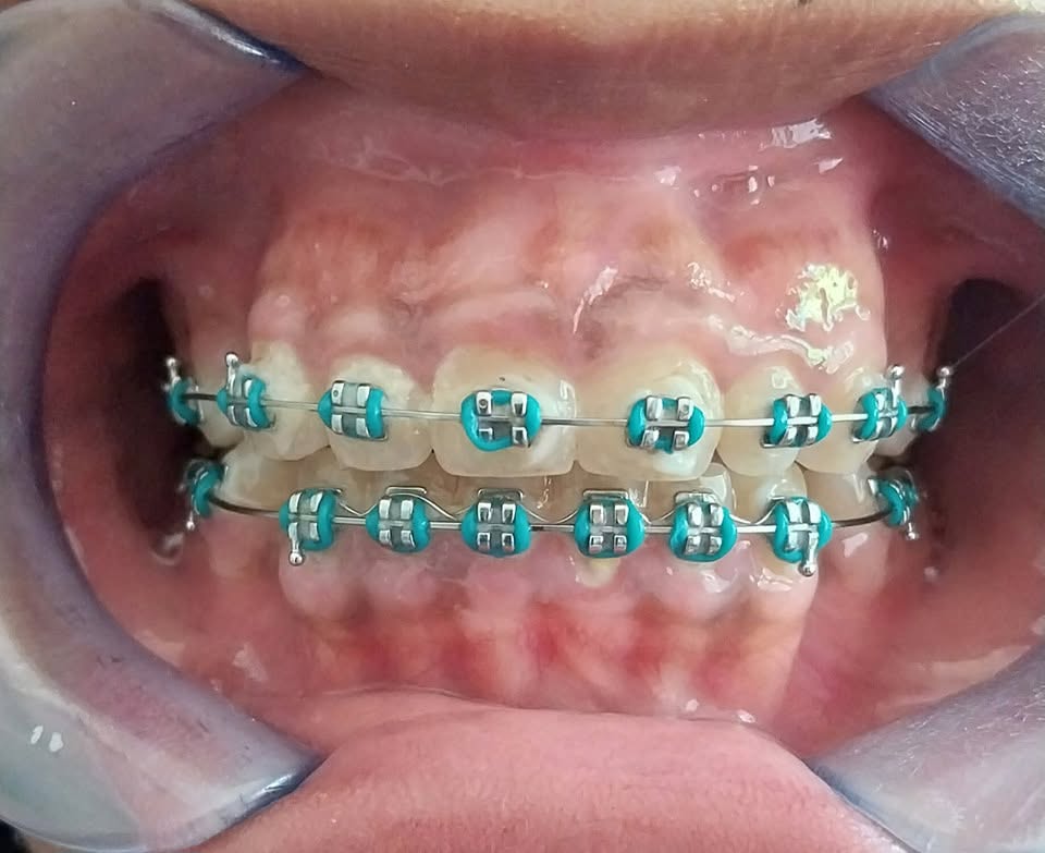 Close-up of a patient's teeth with orthodontic braces mid-treatment